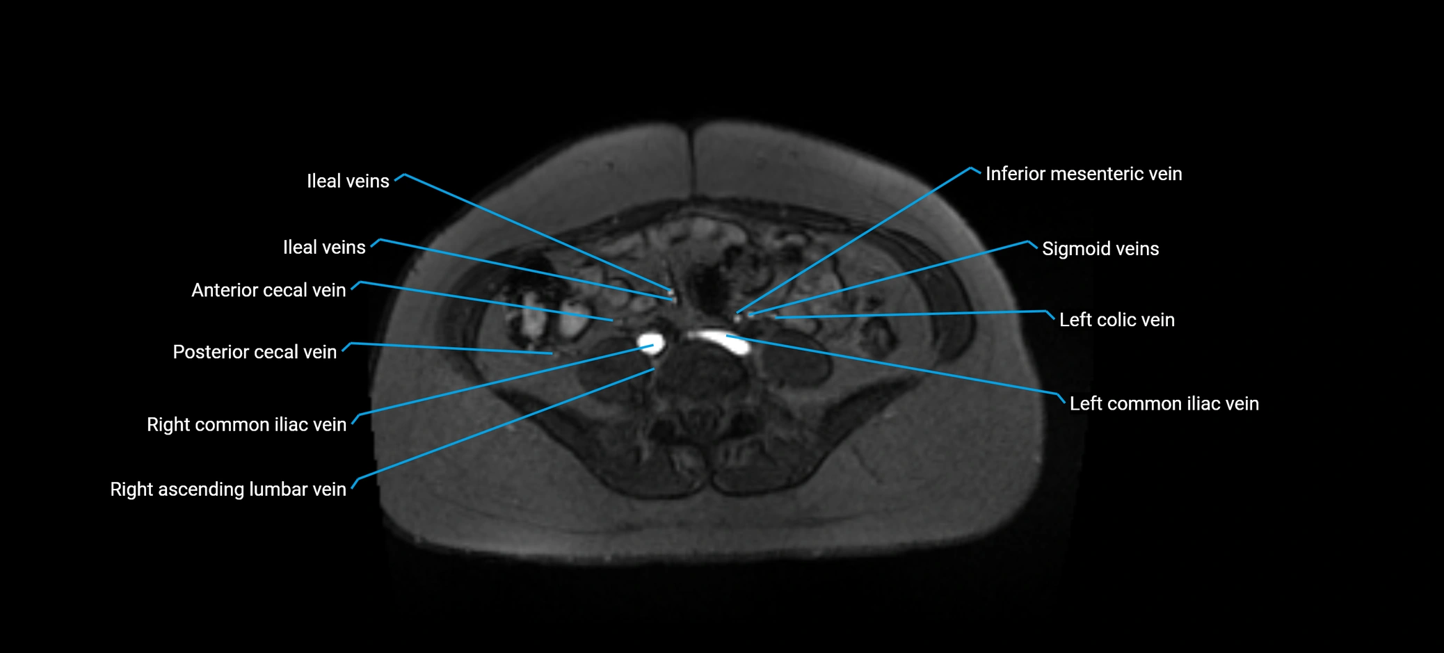 MRV abdomen pelvis & lower limb axial cross sectional anatomy labelled MRI image 122 (1).webp